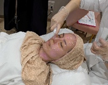 薬剤導入（ローラー型プローブ）